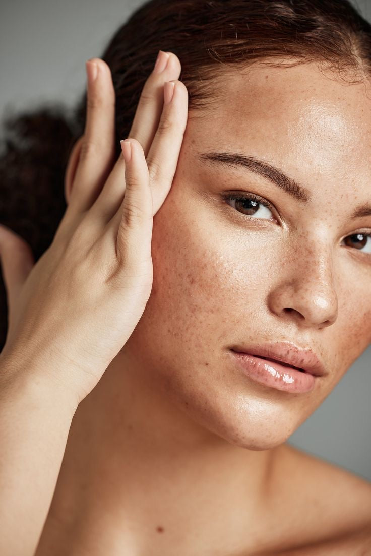 Melasma